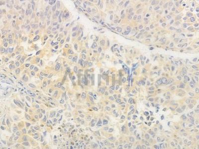 RAB11A Antibody - DF6301 at 1/100 staining human lung squamous cell carcinoma by IHC-P.