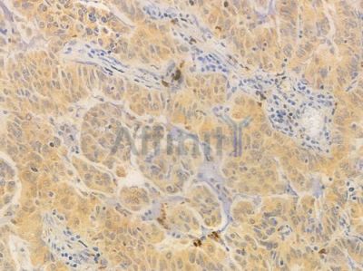 ETS1 Antibody - DF6488 at 1/100 staining human lung adenocarcinoma by IHC-P.