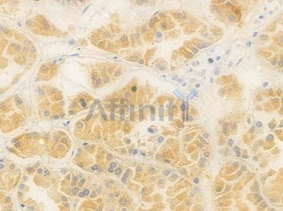 RBP4 Antibody - DF6491 at 1/100 staining human renal cell carcinoma by IHC-P.