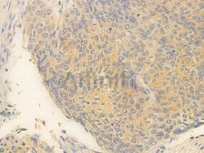 SPARC Antibody - DF6503 at 1/100 staining human cervical carcinoma by IHC-P.