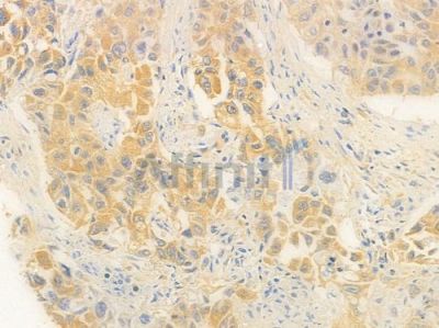NOX2 Antibody - DF6520 at 1/100 staining human lung squamous cell carcinoma by IHC-P.