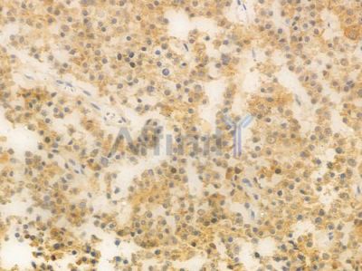 DNA Polymerase beta Antibody - DF6552 at 1/100 staining human pituitary adenoma by IHC-P.