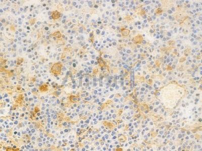 Annexin V Antibody - DF6580 at 1/100 staining human non-Hodgkin lymphoma by IHC-P.
