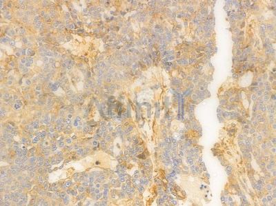 Annexin V Antibody - DF6580 at 1/100 staining human ovarian carcinoma by IHC-P.