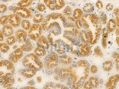 GGT1 Antibody - DF6610 at 1/100 staining human renal cell carcinoma by IHC-P.