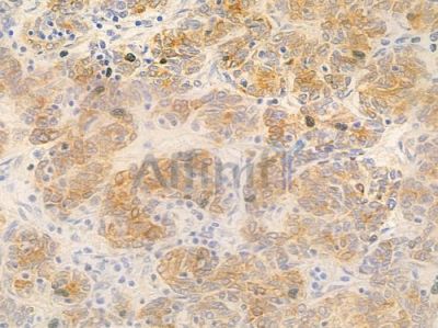 MEF2C Antibody - DF7036 at 1/100 staining human thymoma by IHC-P.
