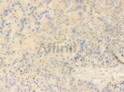 PAR4 Antibody - DF7165 at 1/100 staining human hepatocellular carcinoma by IHC-P.