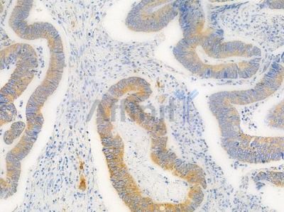 ERAB Antibody - DF7347 at 1/100 staining human renal cell carcinoma by IHC-P.