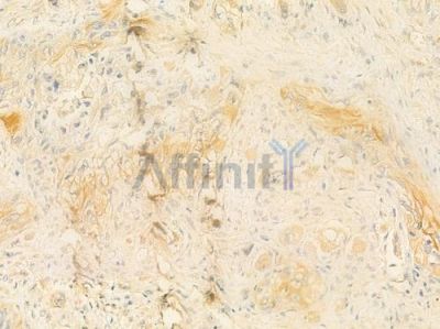 ICAM1 Antibody - DF7413 at 1/100 staining human tongue carcinoma by IHC-P.