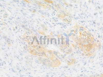 alpha 1 Catenin Antibody - DF7428 at 1/100 staining human tongue carcinoma by IHC-P.