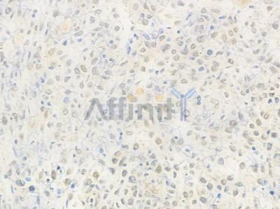 USP7 Antibody - DF7529 at 1/100 staining human non-Hodgkin lymphoma by IHC-P.
