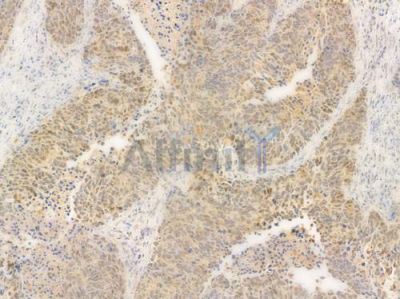 USP7 Antibody - DF7529 at 1/100 staining human large cell lung carcinoma by IHC-P.