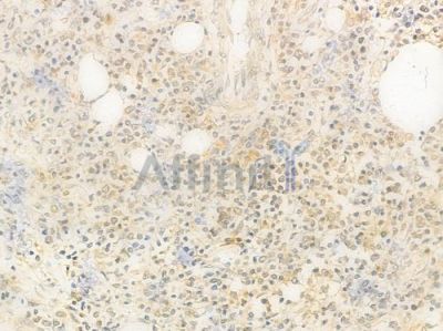USP7 Antibody - DF7529 at 1/100 staining human Hodgkin lymphoma by IHC-P.