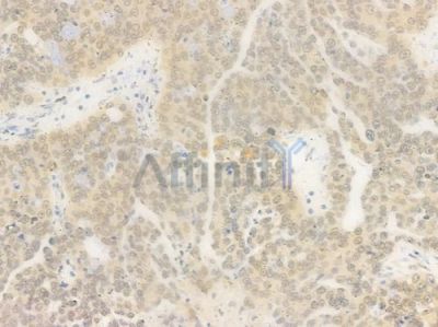 USP7 Antibody - DF7529 at 1/100 staining human ovarian carcinoma by IHC-P.