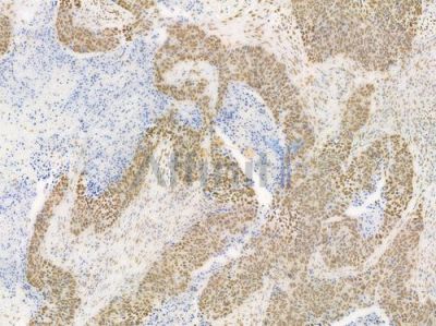 TIF1 beta Antibody - DF7531 at 1/100 staining human large cell lung carcinoma by IHC-P.