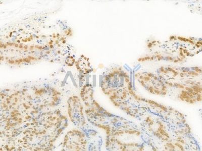 TIF1 beta Antibody - DF7531 at 1/100 staining human thyroid carcinoma by IHC-P.