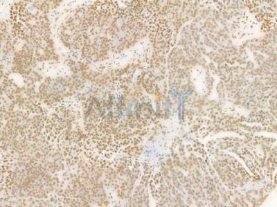 TIF1 beta Antibody - DF7531 at 1/100 staining human ovarian carcinoma by IHC-P.