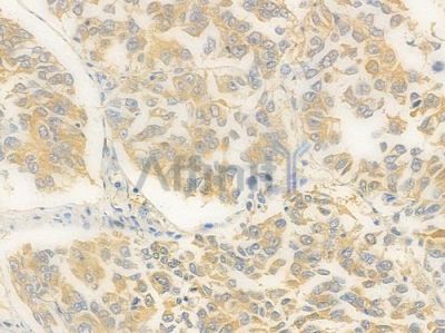 VTCN1 Antibody - DF7849 at 1/100 staining human lung squamous cell carcinoma by IHC-P.