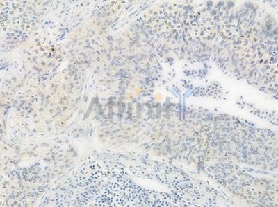 CUL4B Antibody - DF7852 at 1/100 staining human cervical carcinoma by IHC-P.