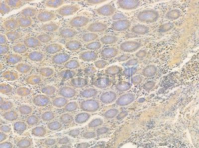 HHEX Antibody - DF7868 at 1/100 staining human colon carcinoma by IHC-P.
