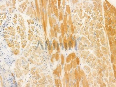 GHR Antibody - DF8425 at 1/100 staining human tongue carcinoma by IHC-P.