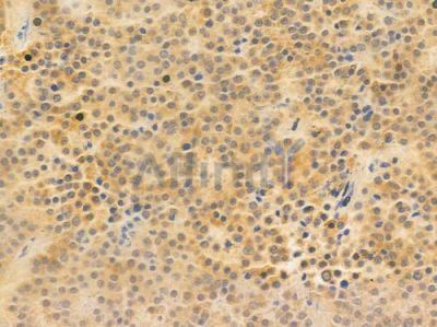 eIF5A2 Antibody - DF8538 at 1/100 staining human pituitary adenoma by IHC-P.
