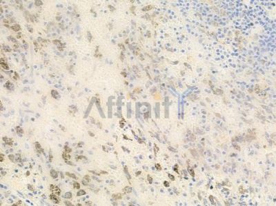 IL32 Antibody - DF8566 at 1/100 staining human melanoma by IHC-P.