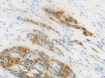 ZO-2 Antibody - DF8632 at 1/100 staining human pancreatic carcinoma by IHC-P.