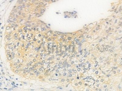 ITGA8 Antibody - DF8993 at 1/100 staining human cervical carcinoma by IHC-P.