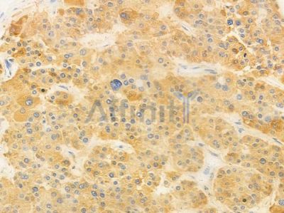 RPS10 Antibody - DF9116 at 1/100 staining human hepatocellular carcinoma by IHC-P.