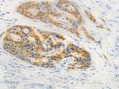 RPL13A Antibody - DF9126 at 1/100 staining human pancreatic carcinoma by IHC-P.