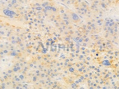 ANXA11 Antibody - DF9215 at 1/100 staining human hepatocellular carcinoma by IHC-P.