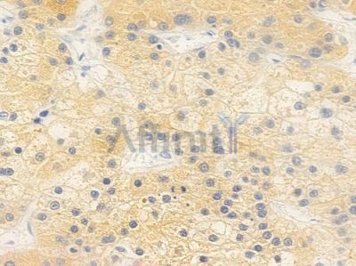 PDE2A Antibody - DF9370 at 1/100 staining human hepatocellular carcinoma by IHC-P.