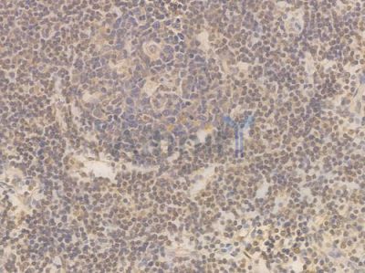 NF-kB p65 Recombinant Rabbit mAb - BF3002 at 1/100 staining Human lymph node carcinoma by IHC-P.