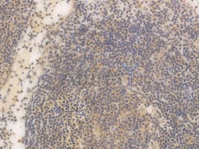 Phospho-mTOR (Ser2448) Recombinant Rabbit mAb - BF3025 at 1/100 staining Human lymph node carcinoma by IHC-P.