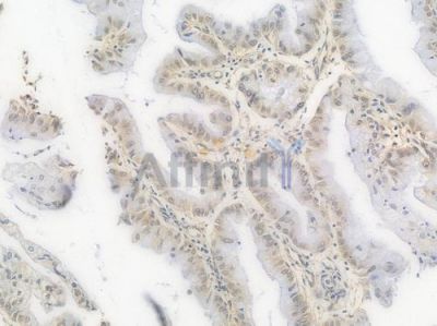 Phospho-mTOR (Ser2448) Recombinant Rabbit mAb - BF3025 at 1/100 staining Human pancreatic carcinoma by IHC-P.