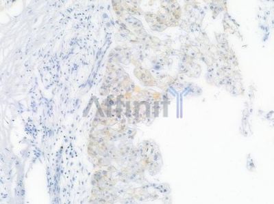 IKB alpha Recombinant Rabbit mAb - BF3027 at 1/100 staining Human pancreatic carcinoma by IHC-P.