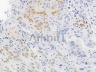 Phospho-STAT3 (Tyr705) Recombinant Rabbit mAb - BF3033 at 1/100 staining Human intestinal carcinoma by IHC-P.