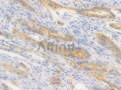 E-cadherin Recombinant Rabbit mAb - BF3053 at 1/100 staining Human intestinal carcinoma by IHC-P.