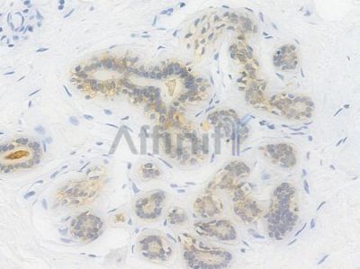 E-cadherin Recombinant Rabbit mAb - BF3053 at 1/100 staining Human breast carcinoma by IHC-P.