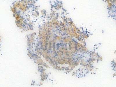 Phospho-MLKL (Ser358) Recombinant Rabbit mAb - BF3055 at 1/100 staining Human testicular carcinoma by IHC-P.