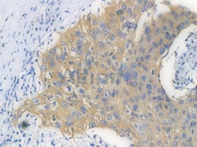 EGFR Recombinant Rabbit mAb - BF3085 at 1/100 staining Human esophageal carcinoma by IHC-P.