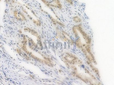 Phospho-Histone H2A.X (Ser139) Recombinant Rabbit mAb - BF3088 at 1/100 staining Human intestinal carcinoma by IHC-P.