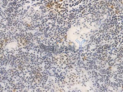 Phospho-Histone H2A.X (Ser139) Recombinant Rabbit mAb - BF3088 at 1/100 staining Human lymph node carcinoma by IHC-P.