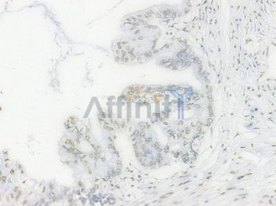 Histone H2A.X Recombinant Rabbit mAb - BF3131 at 1/100 staining Human pancreatic carcinoma by IHC-P.