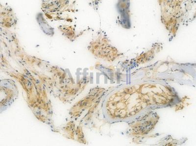 PKA alpha/beta/gamma CAT Recombinant Rabbit mAb - BF3143 at 1/100 staining Human testicular carcinoma by IHC-P.
