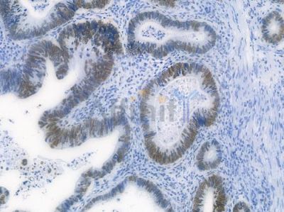 c-Jun Recombinant Rabbit mAb - BF3152 at 1/100 staining Human lung carcinoma by IHC-P.