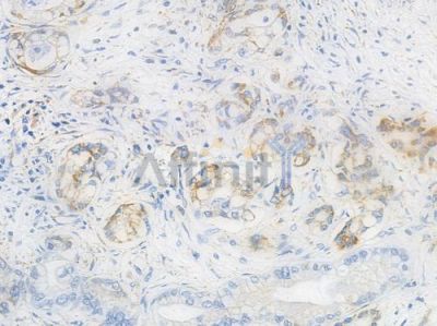 MMP3 Recombinant Rabbit mAb - BF3157 at 1/100 staining Human pancreatic carcinoma by IHC-P.