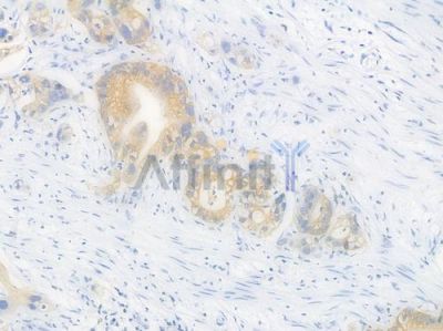 Hexokinase II Recombinant Rabbit mAb - BF3161 at 1/100 staining Human intestinal carcinoma by IHC-P.
