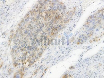 TFAM Recombinant Rabbit mAb - BF3162 at 1/100 staining Human esophageal carcinoma by IHC-P.